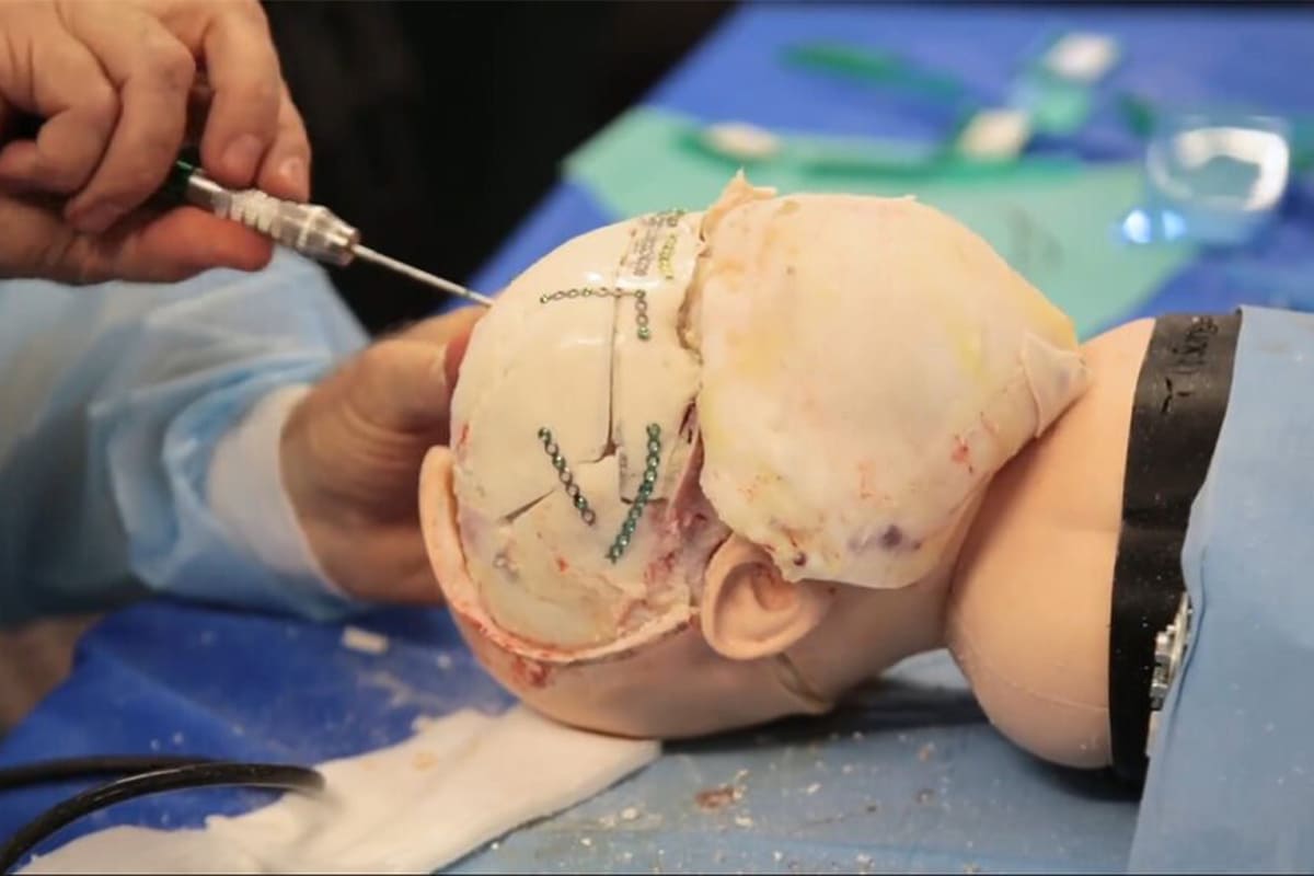 Dr. Kalakoti Chandra Sekhar Reddy | Best Neurosurgeon