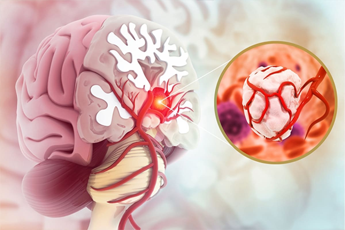 Tumor Treatment | Dr. Kalakoti Chandra Sekhar Reddy - Best Neurologist